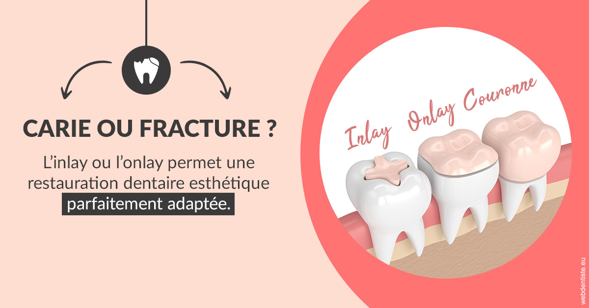 https://www.dentiste-boukobza.fr/T2 2023 - Carie ou fracture 2