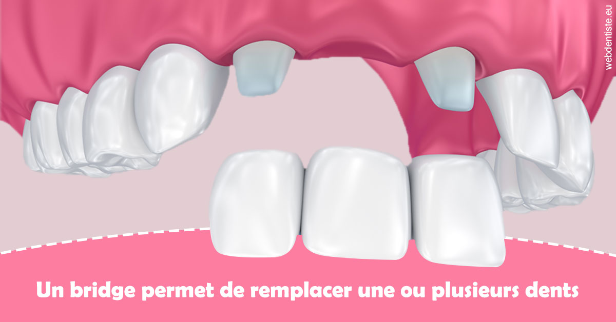https://www.dentiste-boukobza.fr/Bridge remplacer dents 2