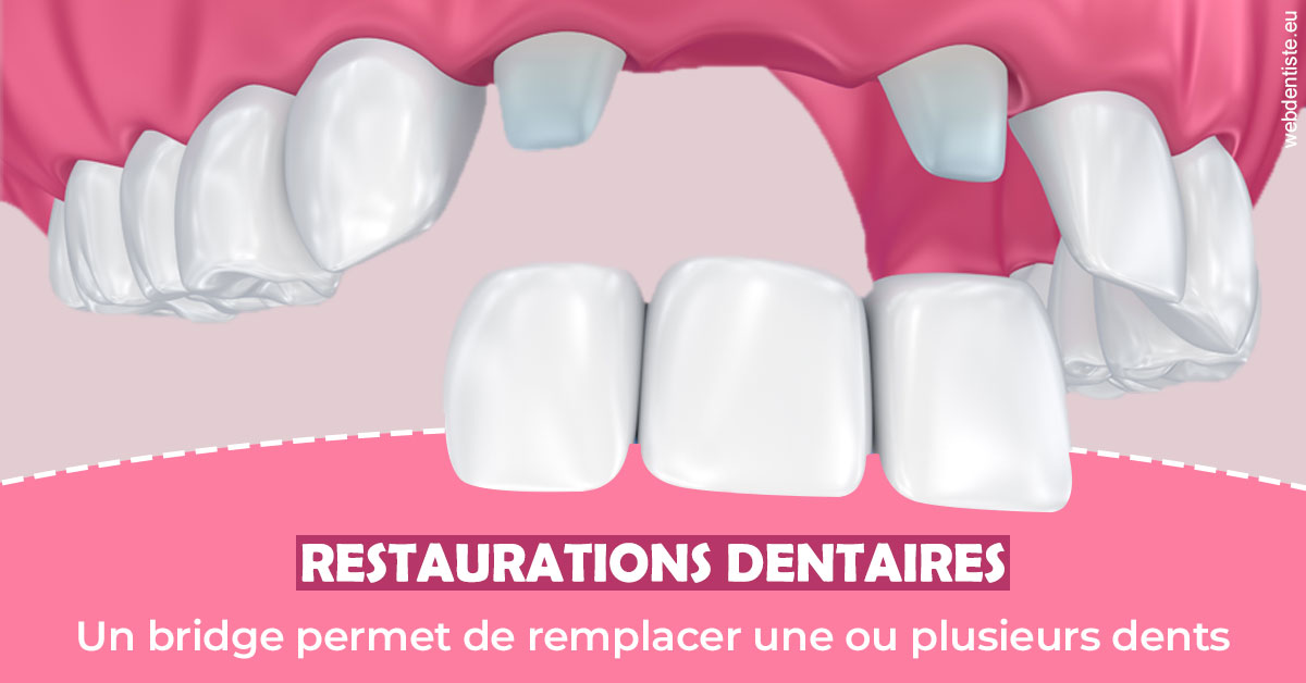 https://www.dentiste-boukobza.fr/Bridge remplacer dents 2