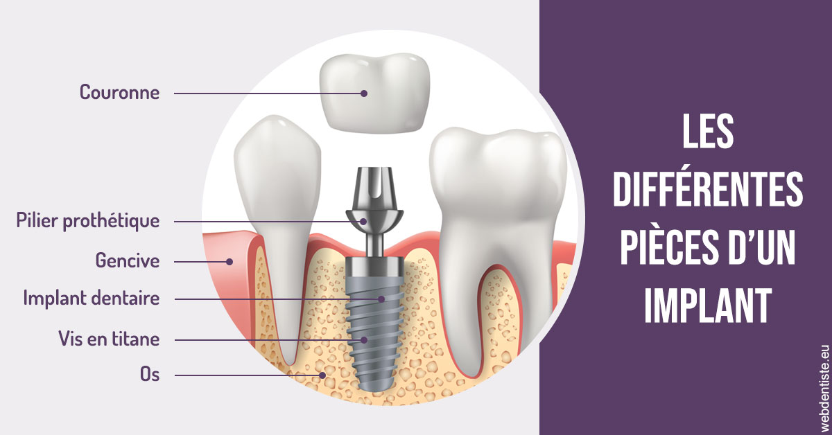 https://www.dentiste-boukobza.fr/Les différentes pièces d’un implant 2