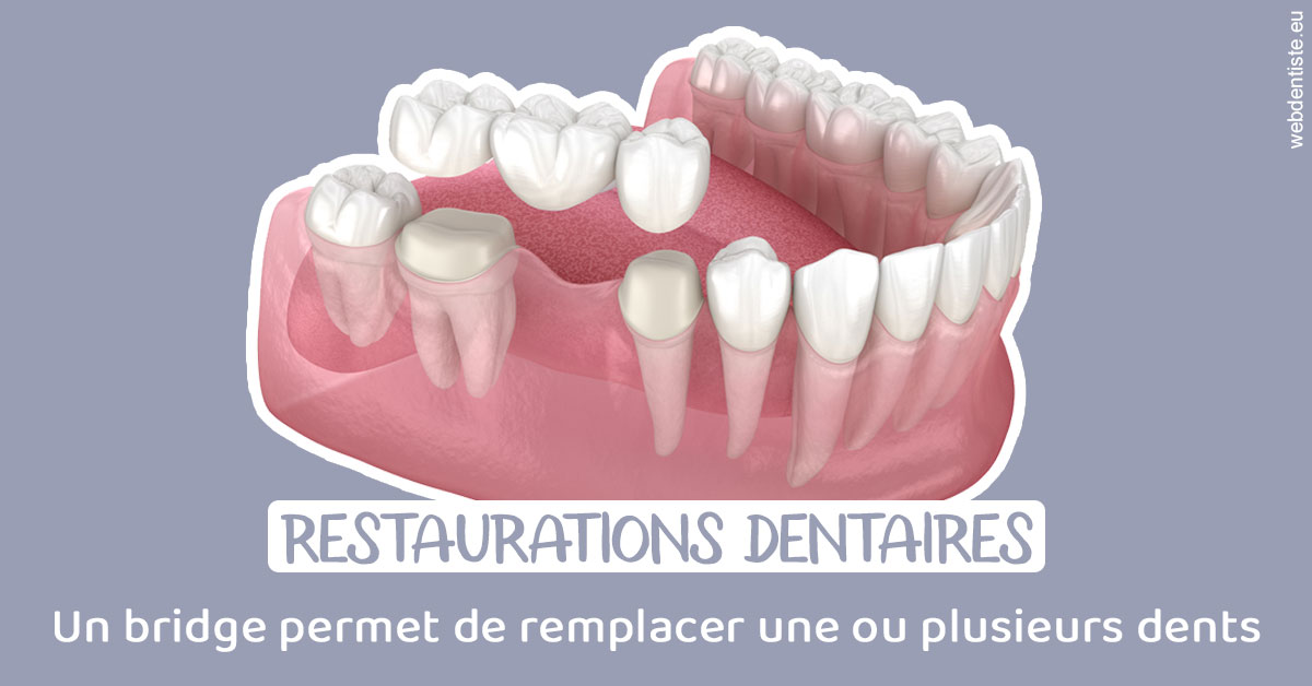 https://www.dentiste-boukobza.fr/Bridge remplacer dents 1