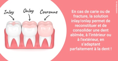 https://www.dentiste-boukobza.fr/L'INLAY ou l'ONLAY 2