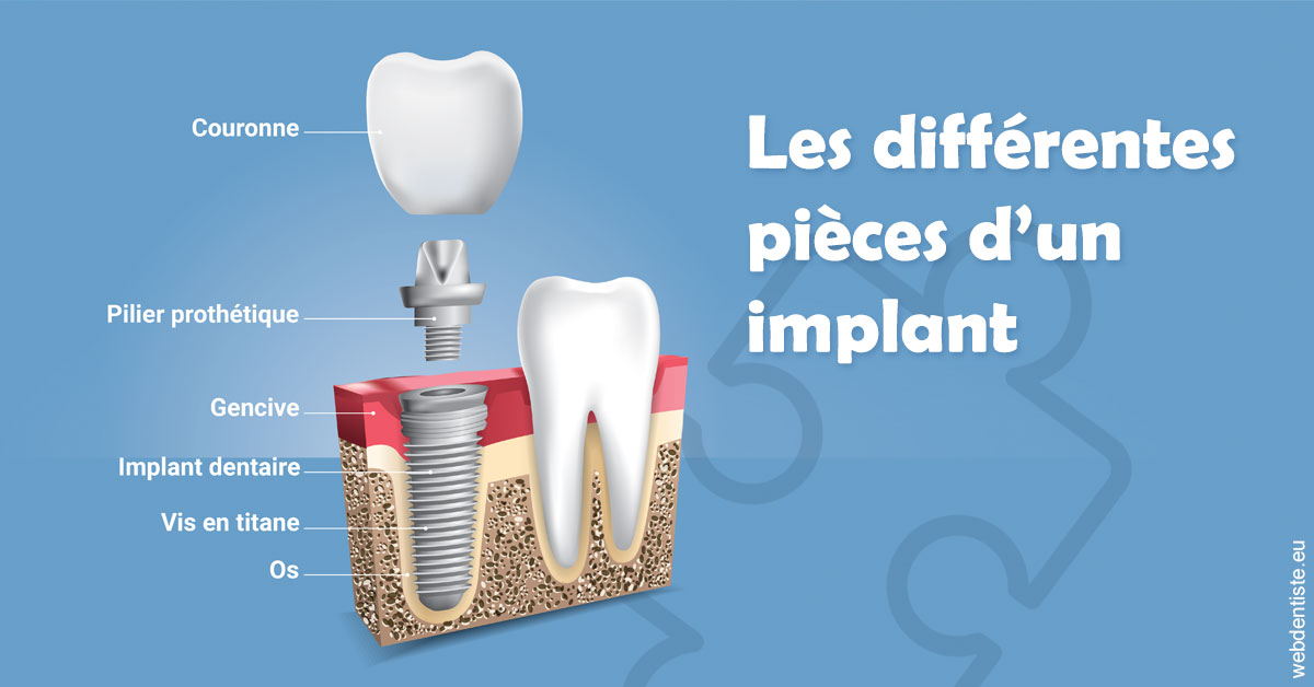 https://www.dentiste-boukobza.fr/Les différentes pièces d’un implant 1